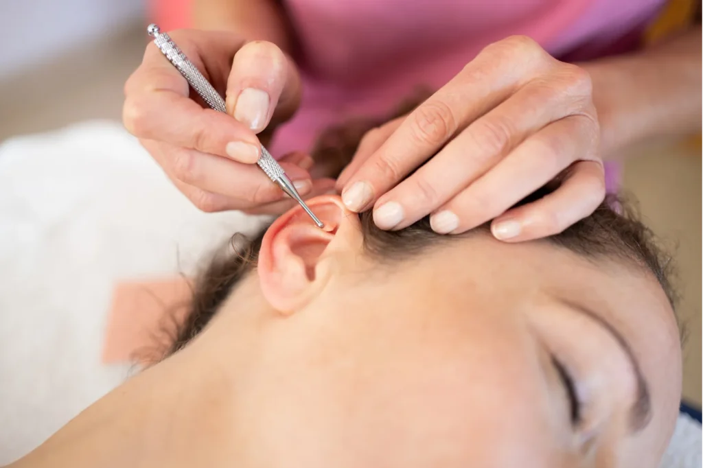 Primer plano de acupuntura auricular: auriculoterapia en Tenerife para aliviar dolor, gestionar estrés y equilibrar emociones con tratamiento personalizado.